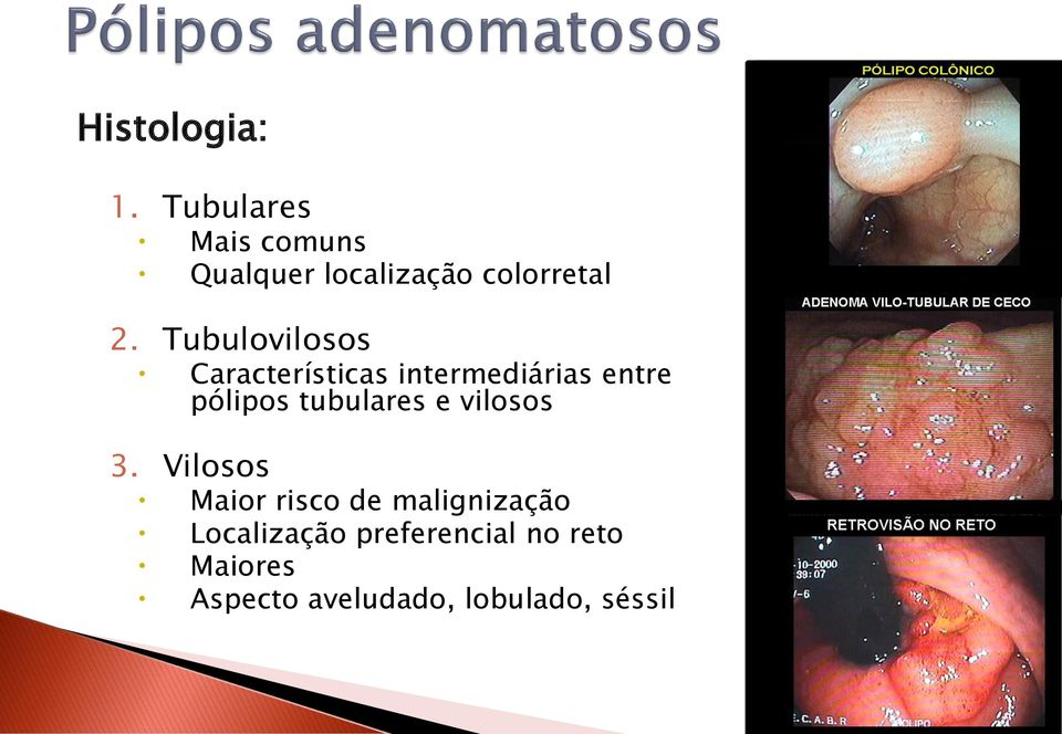 Tubulovilosos Características intermediárias entre pólipos