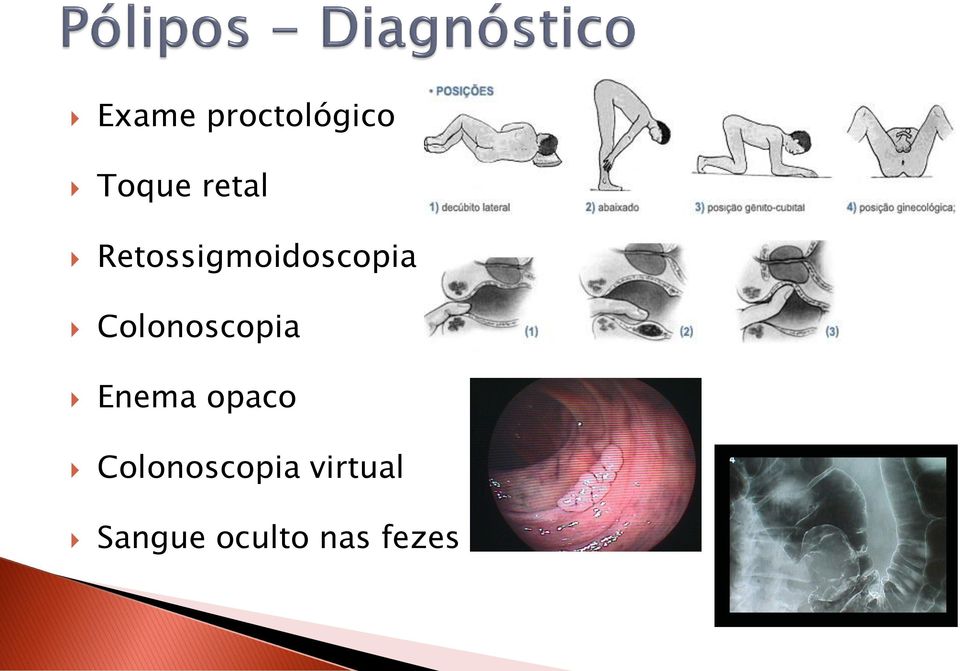 Colonoscopia Enema opaco