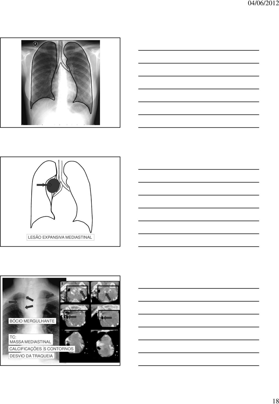 MEDIASTINAL CALCIFICAÇÕES