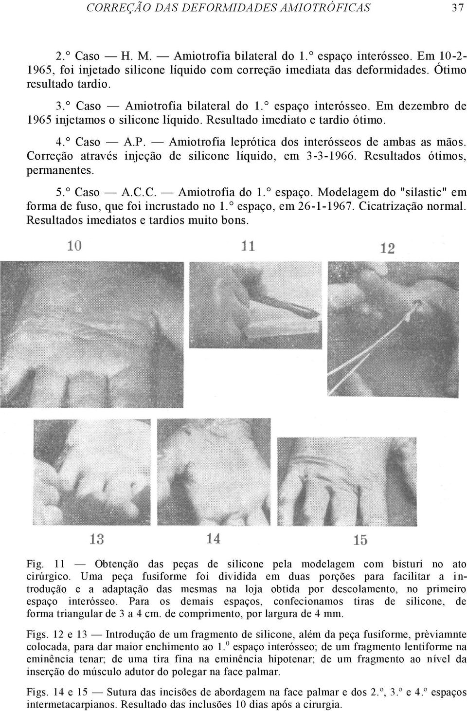 Amiotrofia leprótica dos interósseos de ambas as mãos. Correção através injeção de silicone líquido, em 3-3-1966. Resultados ótimos, permanentes. 5. Caso A.C.C. Amiotrofia do 1. espaço.
