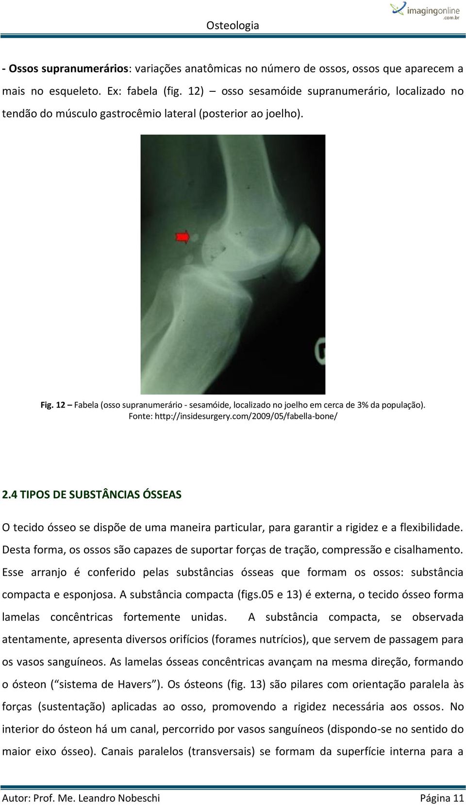 12 Fabela (osso supranumerário - sesamóide, localizado no joelho em cerca de 3% da população). Fonte: http://insidesurgery.com/2009/05/fabella-bone/ 2.