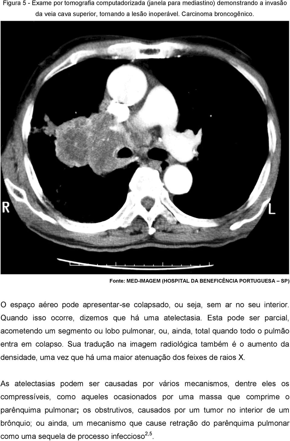 Esta pode ser parcial, acometendo um segmento ou lobo pulmonar, ou, ainda, total quando todo o pulmão entra em colapso.