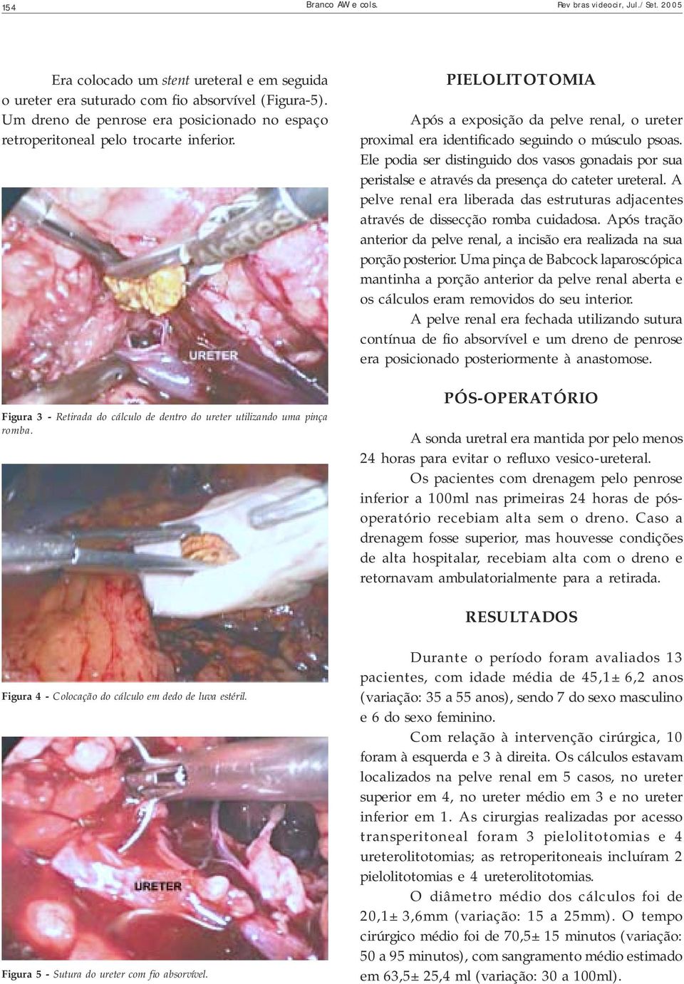 PIELOLITOTOMIA Após a exposição da pelve renal, o ureter proximal era identificado seguindo o músculo psoas.