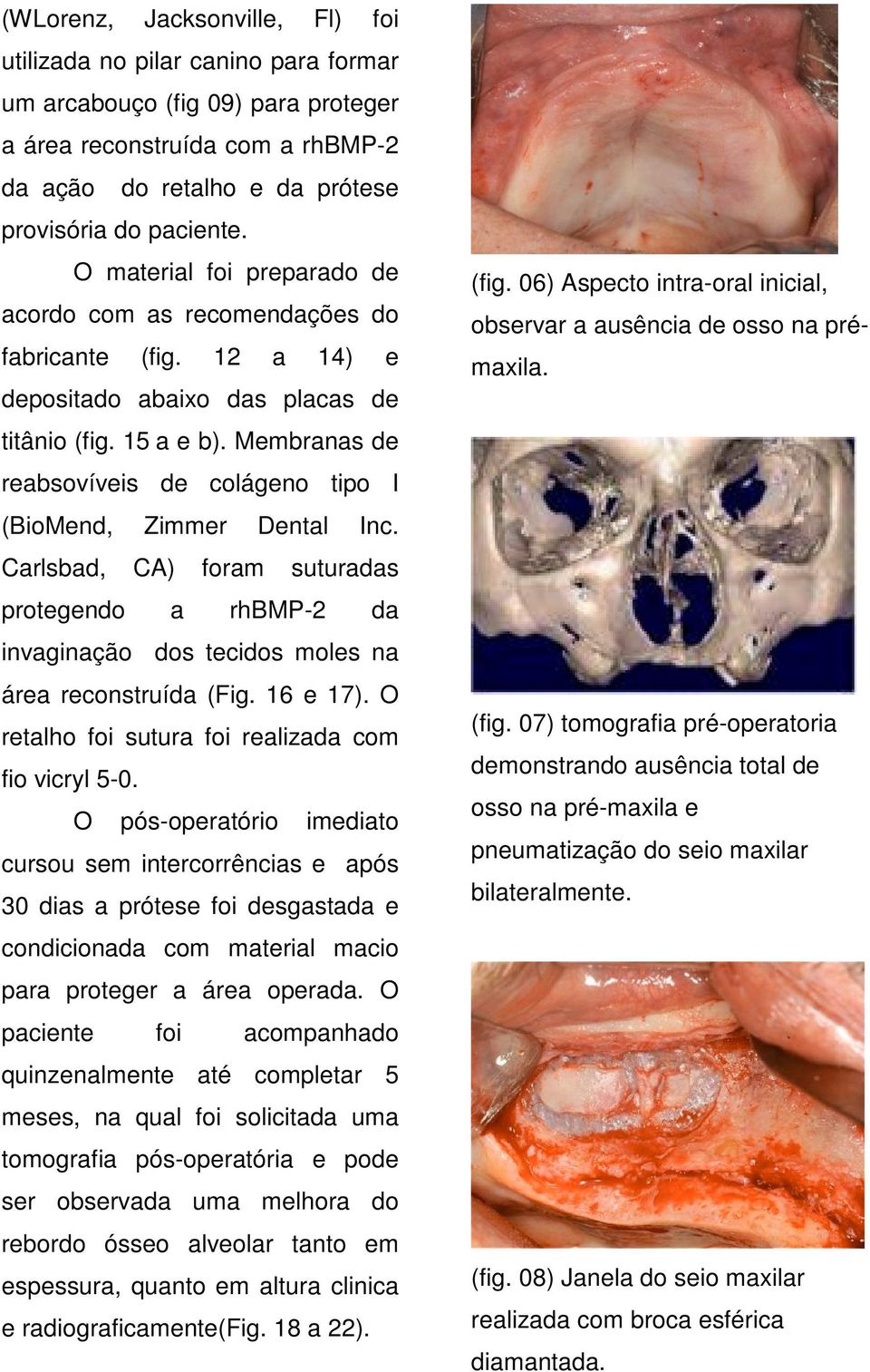 Membranas de reabsovíveis de colágeno tipo I (BioMend, Zimmer Dental Inc. Carlsbad, CA) foram suturadas protegendo a rhbmp-2 da invaginação dos tecidos moles na área reconstruída (Fig. 16 e 17).