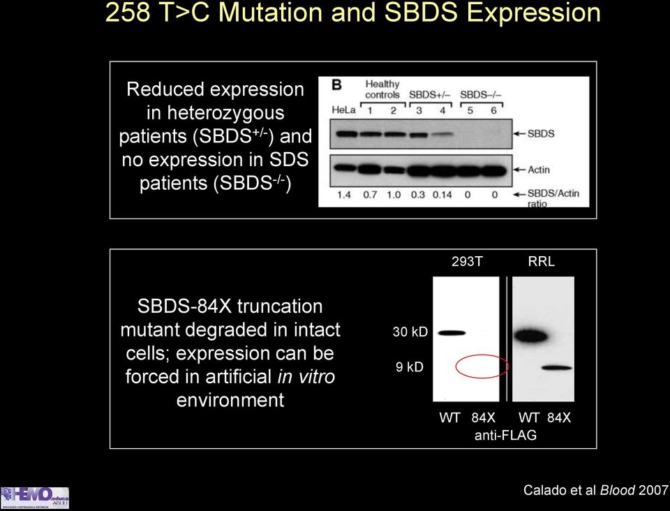 SBDS-84X truncation mutant degraded in intact cells; expression can be forced