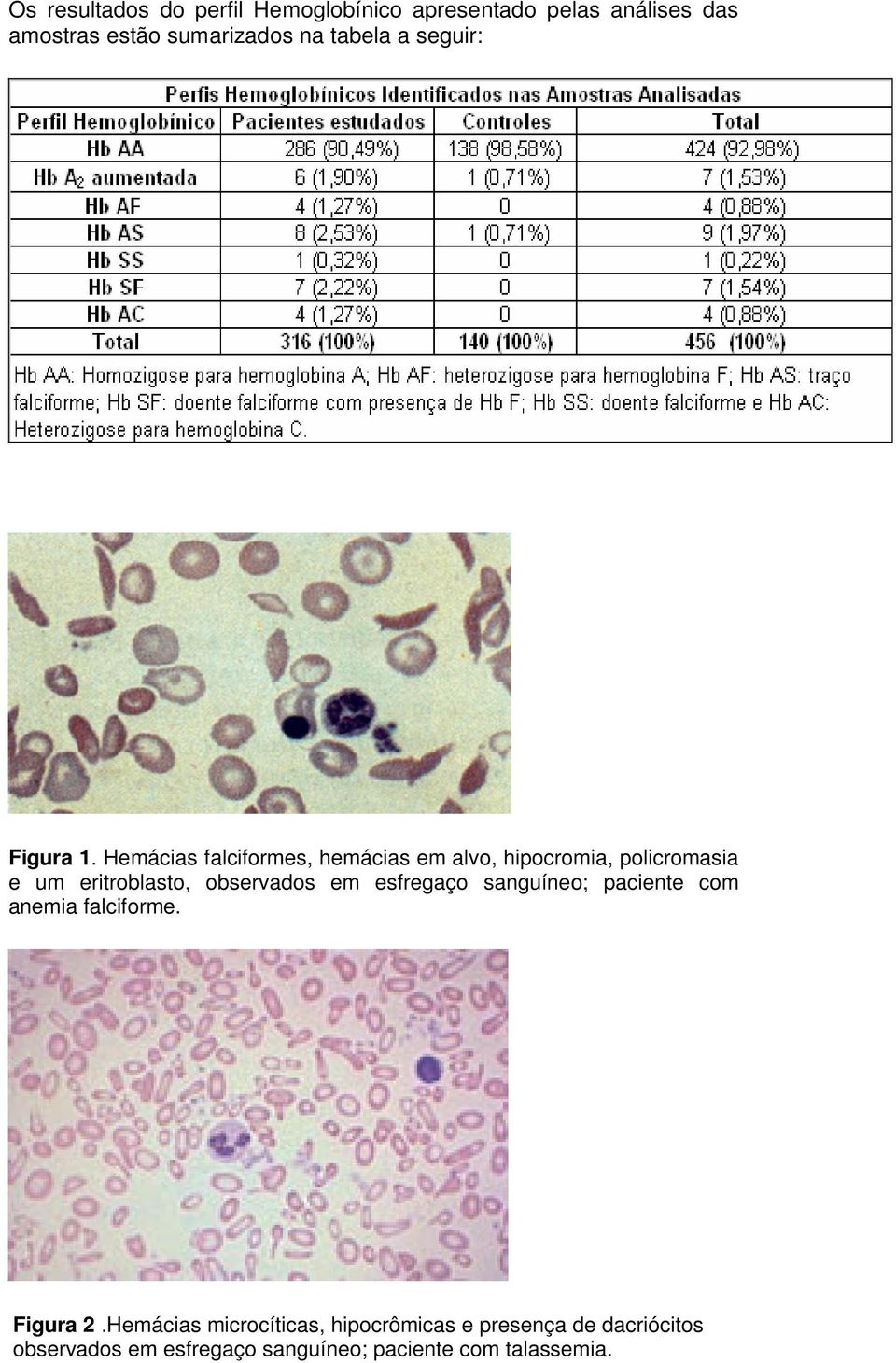 Hemácias falciformes, hemácias em alvo, hipocromia, policromasia e um eritroblasto, observados em