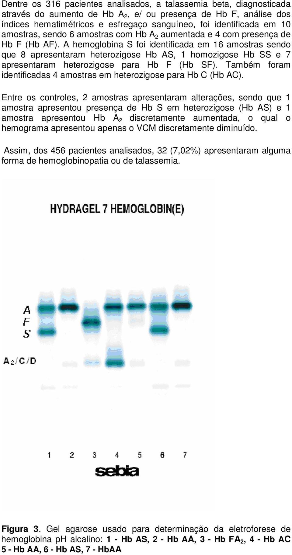 A hemoglobina S foi identificada em 16 amostras sendo que 8 apresentaram heterozigose Hb AS, 1 homozigose Hb SS e 7 apresentaram heterozigose para Hb F (Hb SF).