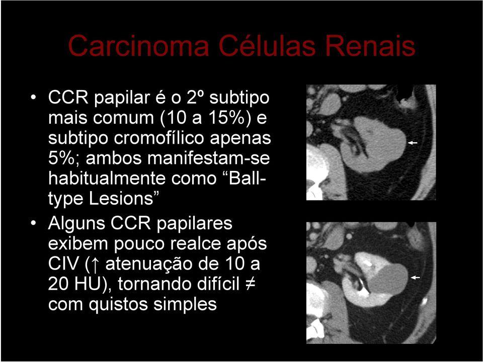 habitualmente como Balltype Lesions Alguns CCR papilares exibem pouco