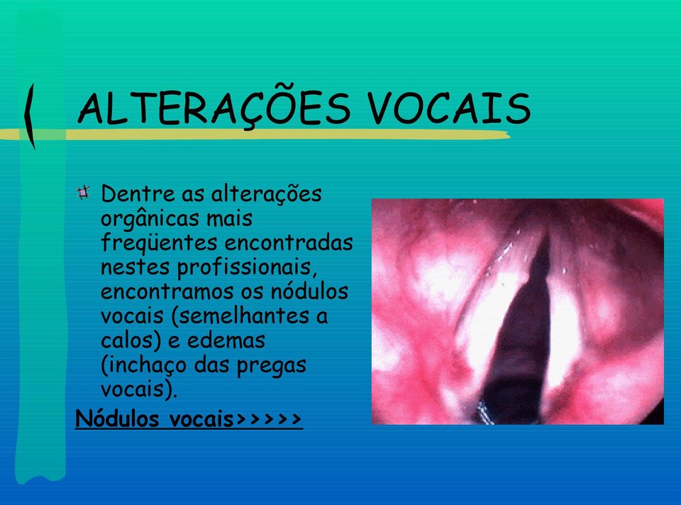 encontramos os nódulos vocais (semelhantes a calos)