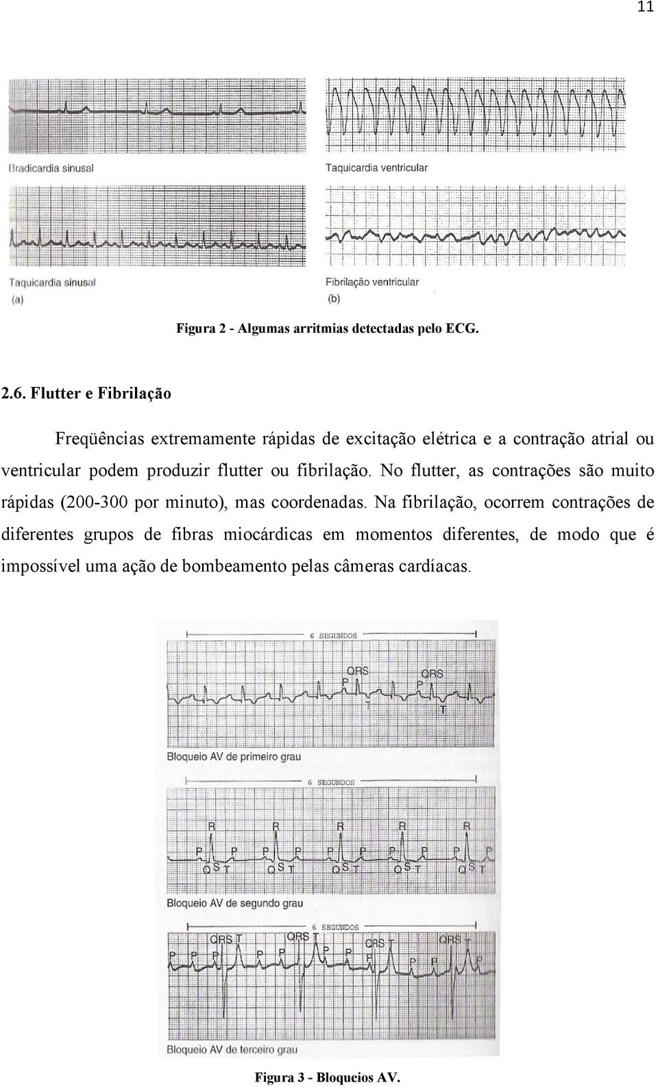 produzir flutter ou fibrilação. No flutter, as contrações são muito rápidas (200-300 por minuto), mas coordenadas.