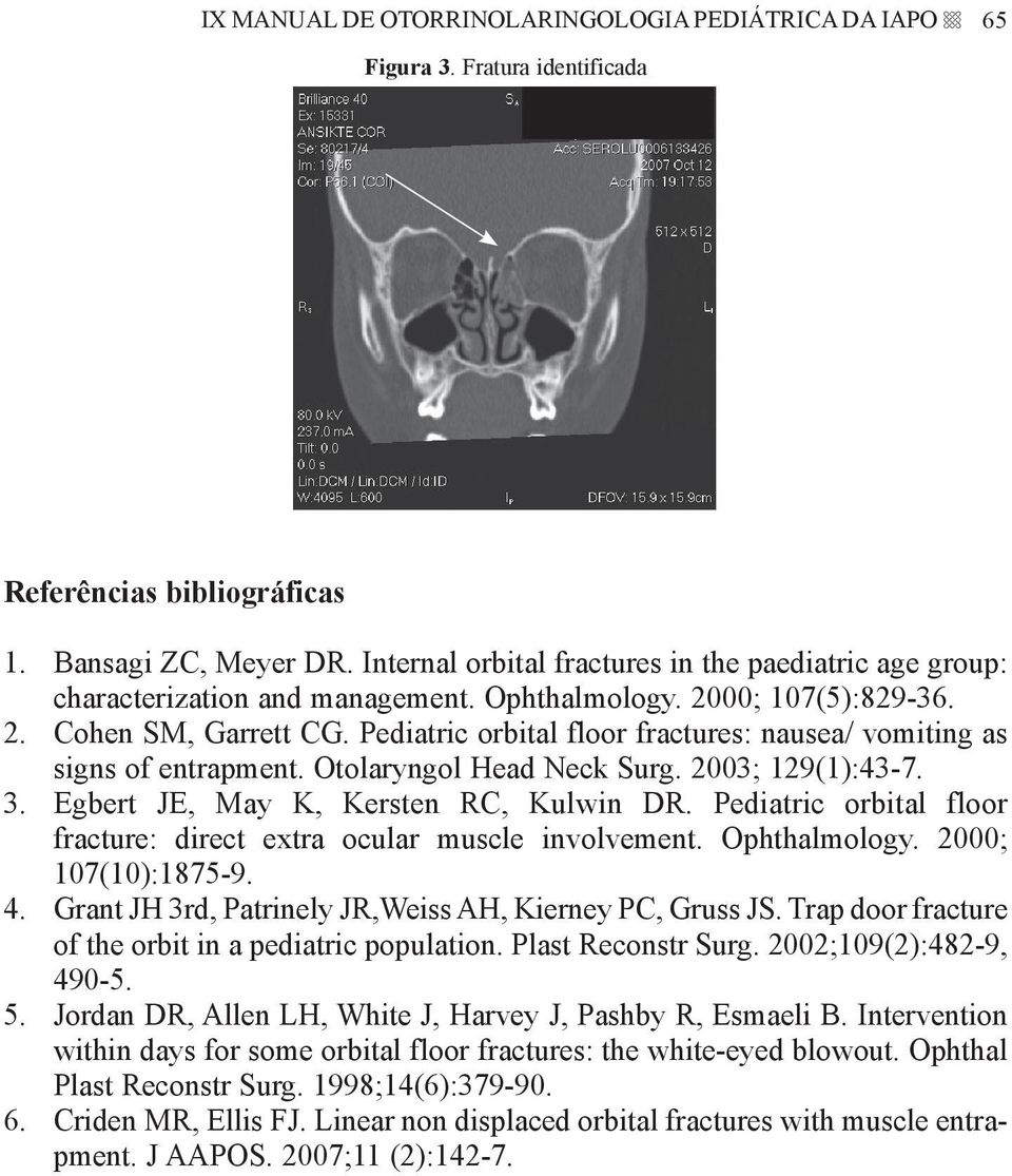 Pediatric orbital floor fractures: nausea/ vomiting as signs of entrapment. Otolaryngol Head Neck Surg. 2003; 129(1):43-7. 3. Egbert JE, May K, Kersten RC, Kulwin DR.