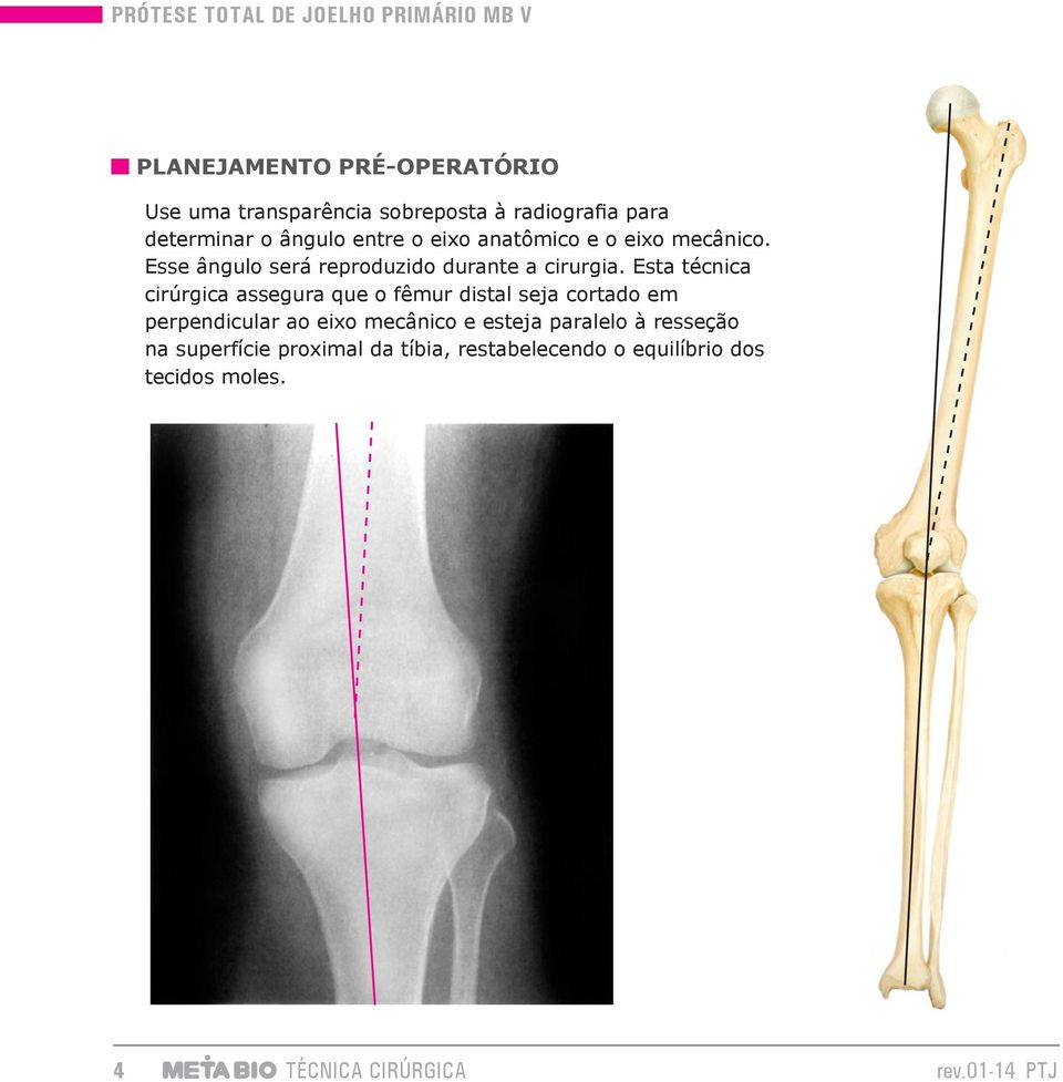 Esta técnica cirúrgica assegura que o fêmur distal seja cortado em perpendicular ao eixo mecânico e