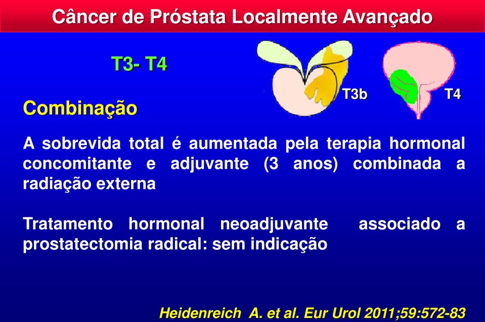 radiação externa Tratamento hormonal neoadjuvante prostatectomia