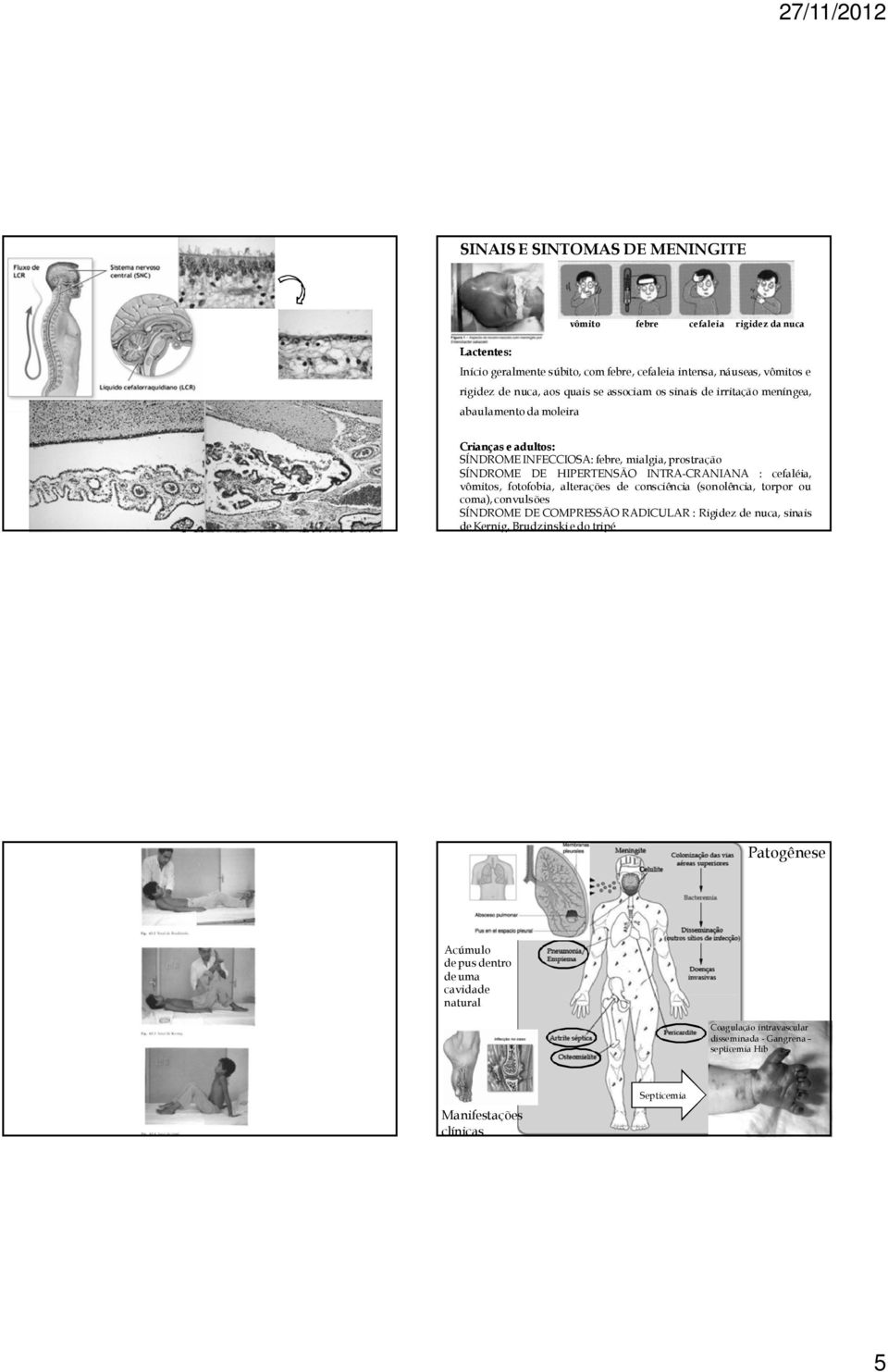 INTRA-CRANIANA : cefaléia, vômitos, fotofobia, alterações de consciência (sonolência, torpor ou coma), convulsões SÍNDROME DE COMPRESSÃO RADICULAR : Rigidez de nuca, sinais