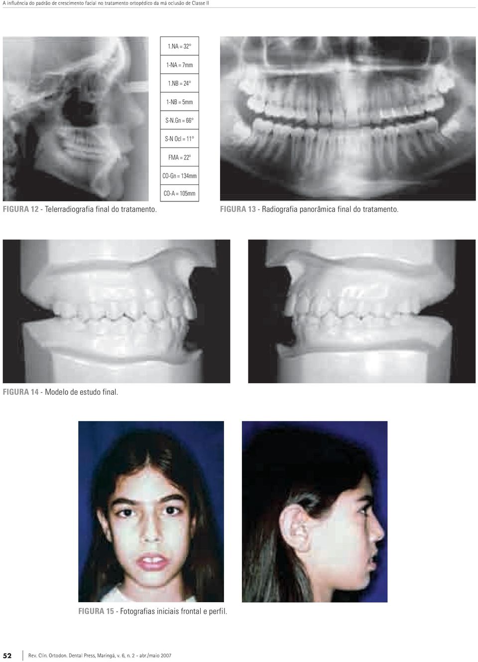 Gn = 66 S-N Ocl = 11 FMA = 22º CO-Gn = 134mm CO-A = 105mm Figura 12 - Telerradiografia final do