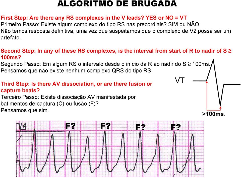 Second Step: In any of these RS complexes, is the interval from start of R to nadir of S 100ms? Segundo Passo: Em algum RS o intervalo desde o início da R ao nadir do S 100ms.