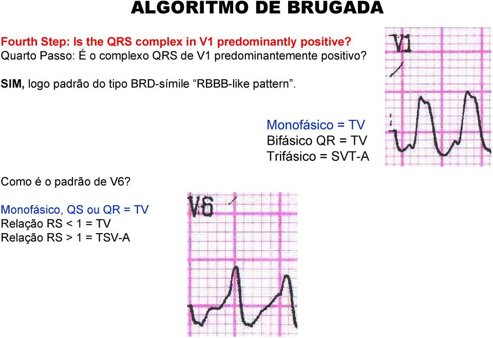 SIM, logo padrão do tipo BRD-símile RBBB-like pattern. Como é o padrão de V6?