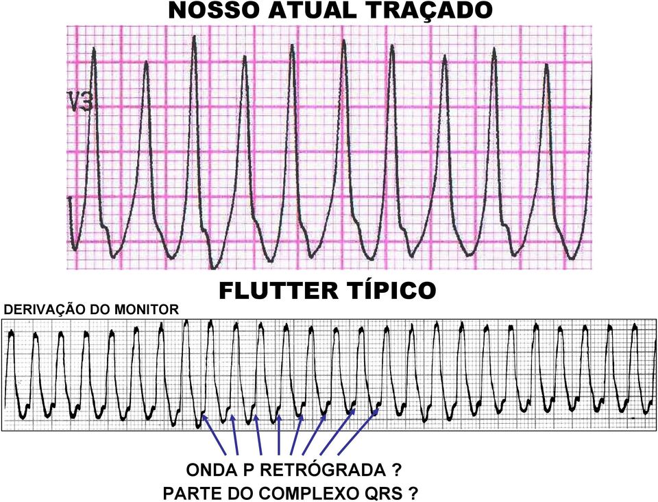 FLUTTER TÍPICO ONDA P