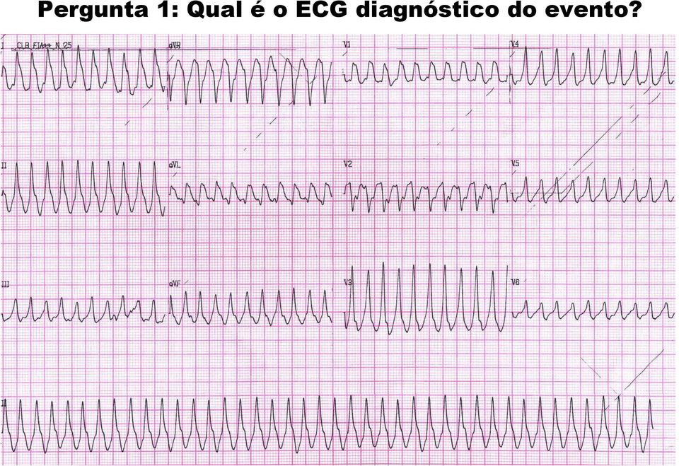 ECG