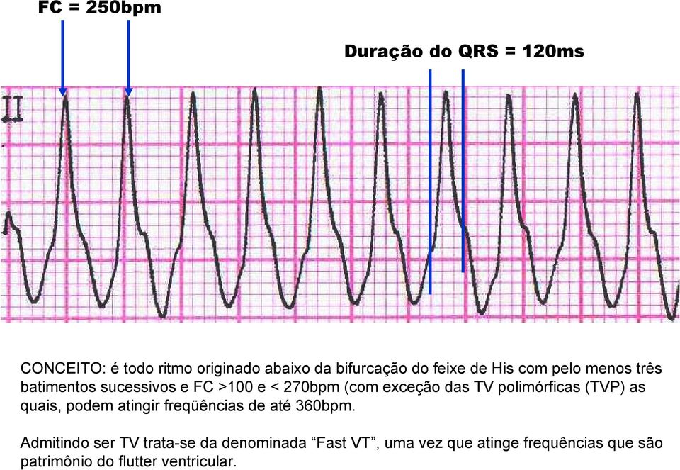TV polimórficas (TVP) as quais, podem atingir freqüências de até 360bpm.