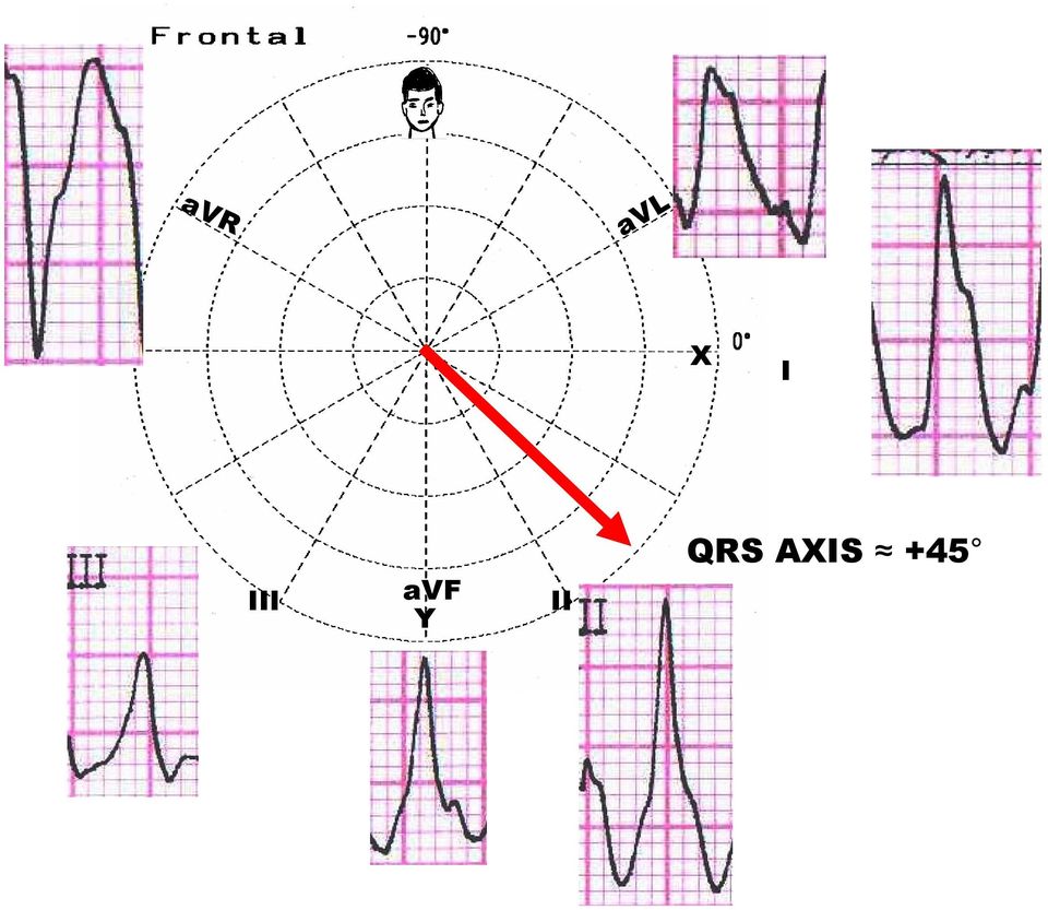 Y II QRS