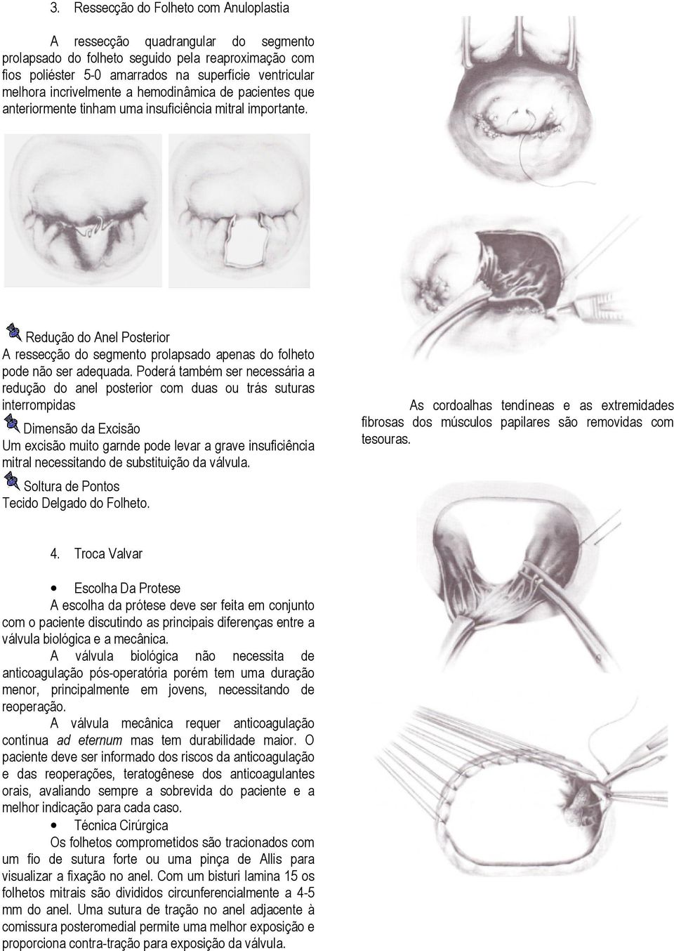 Redução do Anel Posterior A ressecção do segmento prolapsado apenas do folheto pode não ser adequada.