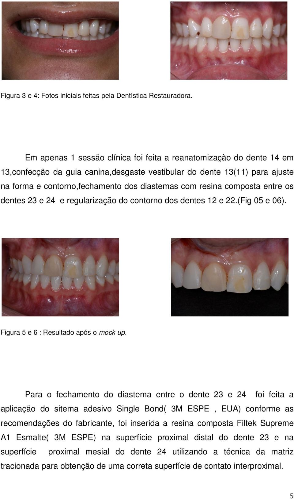 resina composta entre os dentes 23 e 24 e regularização do contorno dos dentes 12 e 22.(Fig 05 e 06). Figura 5 e 6 : Resultado após o mock up.