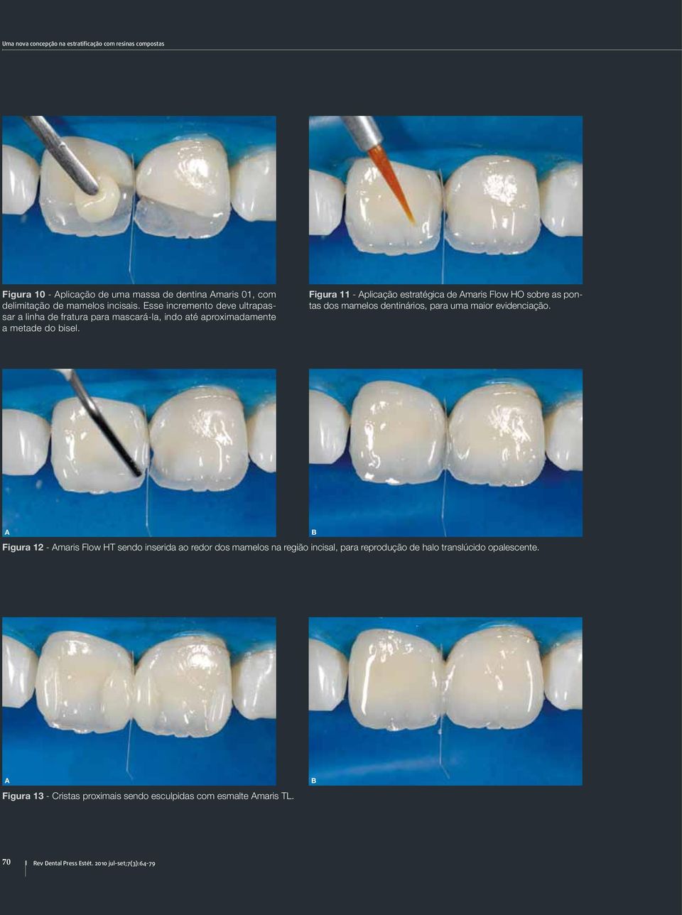 Figura 11 - plicação estratégica de maris Flow HO sobre as pontas dos mamelos dentinários, para uma maior evidenciação.