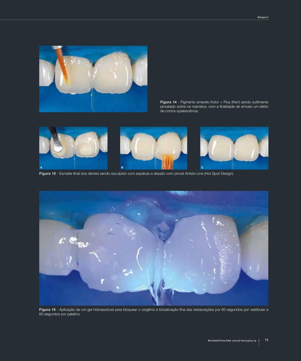 C Figura 15 - Esmalte final dos dentes sendo esculpido com espátula e alisado com pincel rtiste Line (Hot Spot Design).