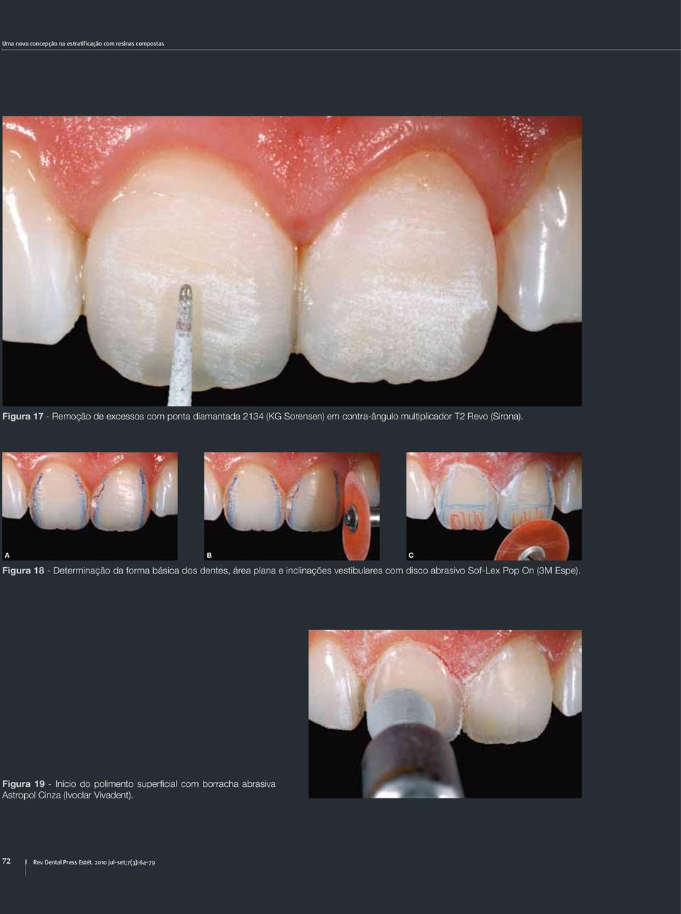 C Figura 18 - Determinação da forma básica dos dentes, área plana e inclinações vestibulares com disco abrasivo