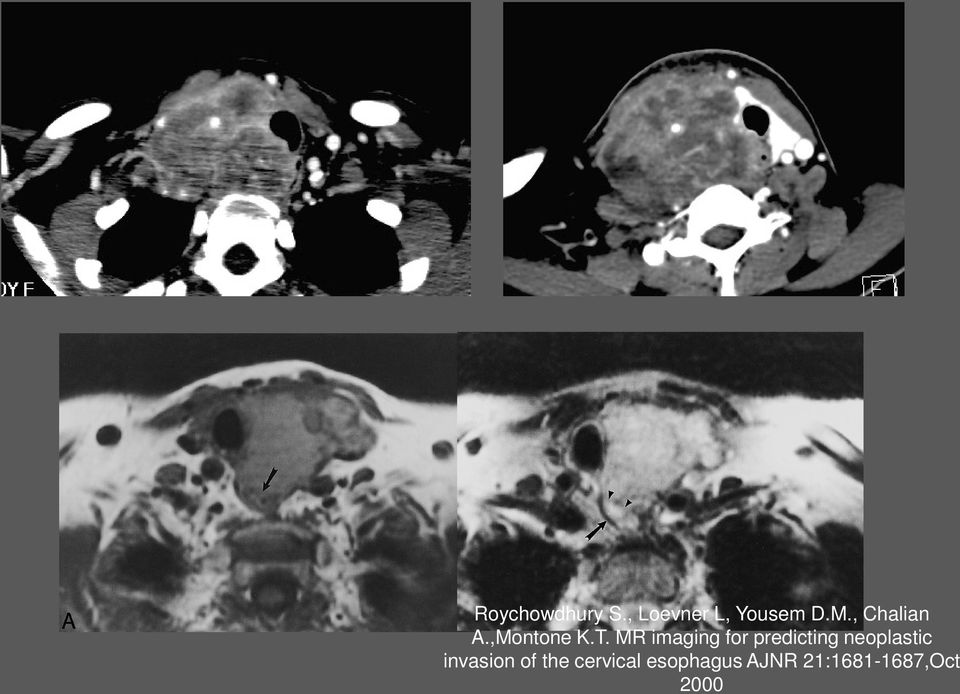 MR imaging for predicting neoplastic