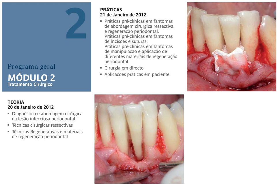 Práticas pré-clínicas em fantomas de manipulação e aplicação de diferentes materiais de regeneração periodontal Cirurgia em directo Aplicações