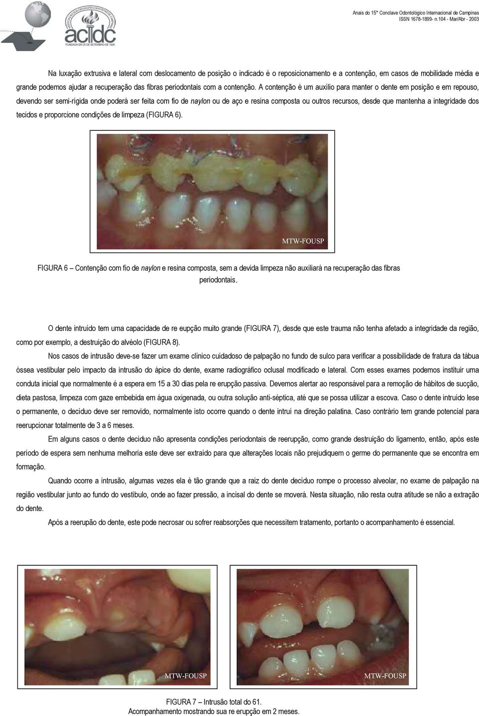 A contenção é um auxílio para manter o dente em posição e em repouso, devendo ser semi-rígida onde poderá ser feita com fio de naylon ou de aço e resina composta ou outros recursos, desde que