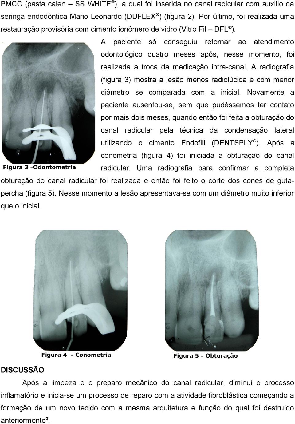 A paciente só conseguiu retornar ao atendimento odontológico quatro meses após, nesse momento, foi realizada a troca da medicação intra-canal.