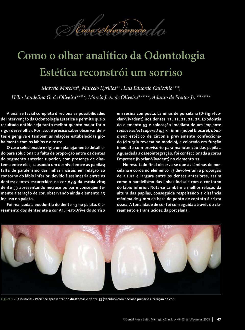 ****** A análise facial completa direciona as possibilidades de intervenção da Odontologia Estética e permite que o resultado obtido seja tanto melhor quanto maior for o rigor desse olhar.