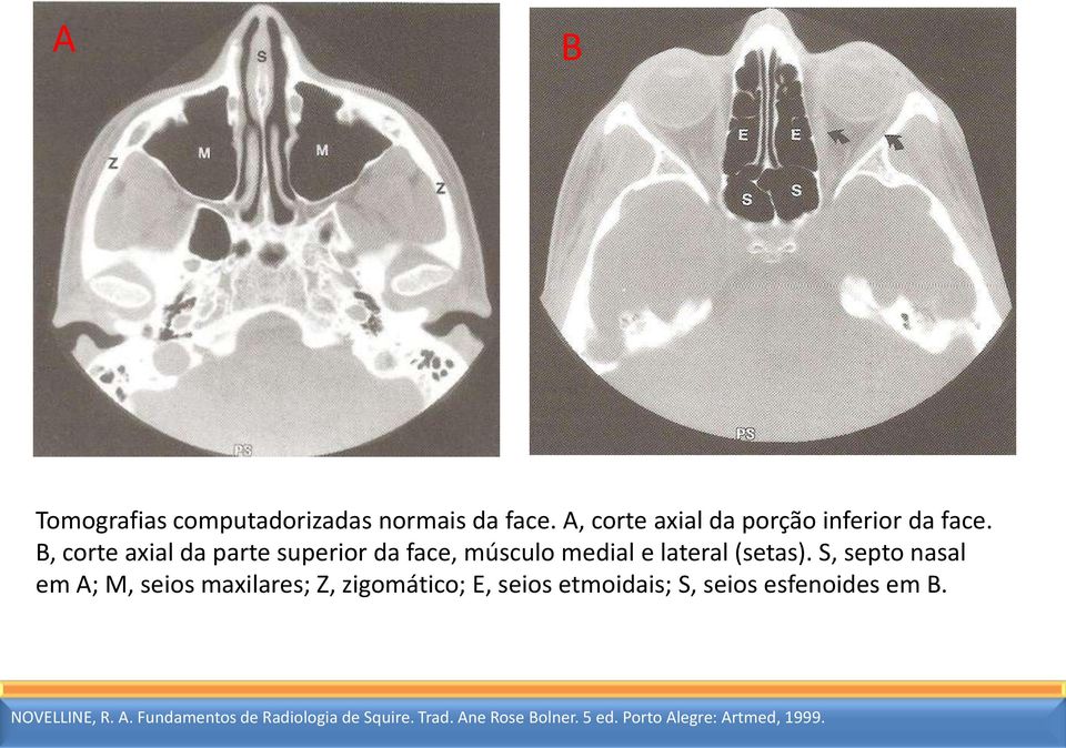 S, septo nasal em A; M, seios maxilares; Z, zigomático; E, seios etmoidais; S, seios esfenoides