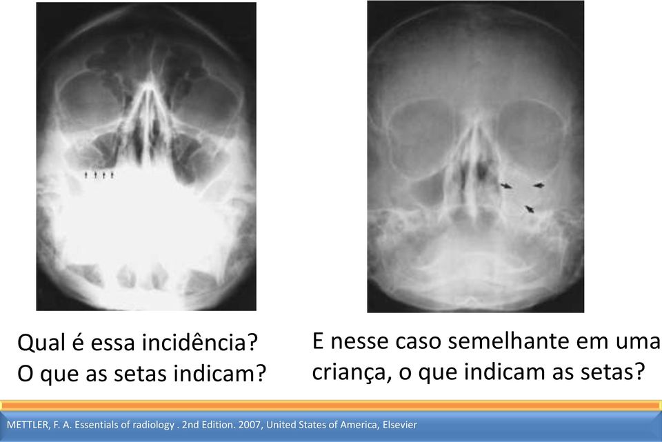 indicam as setas? METTLER, F. A.