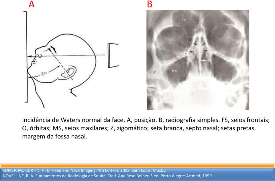 pretas, margem da fossa nasal. SOM, P. M.; CURTIN, H. D. Head and Neck Imaging.