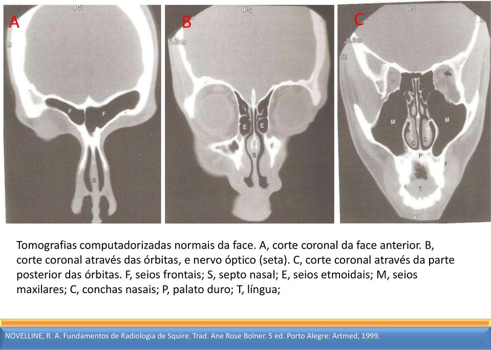 C, corte coronal através da parte posterior das órbitas.