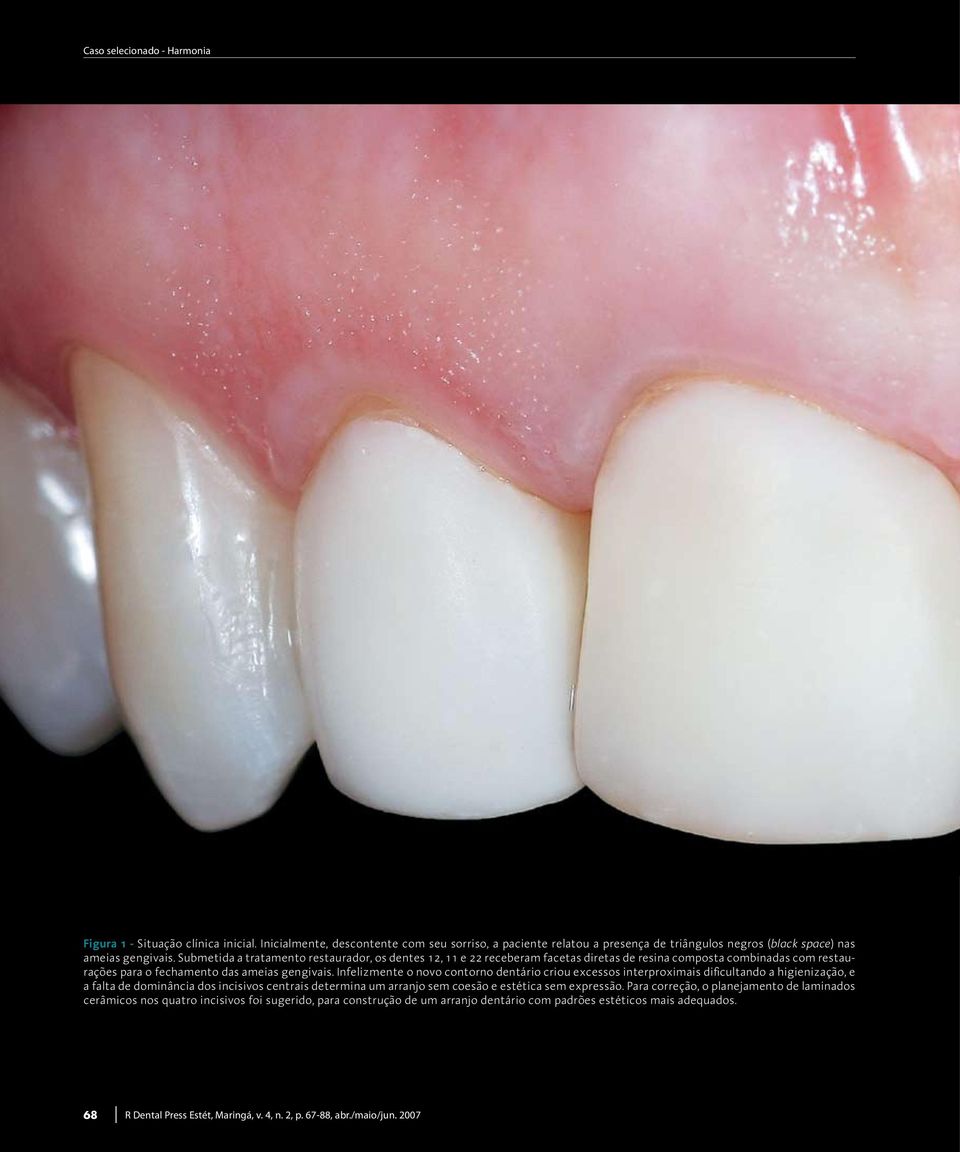 Infelizmente o novo contorno dentário criou excessos interproximais dificultando a higienização, e a falta de dominância dos incisivos centrais determina um arranjo sem coesão e estética sem