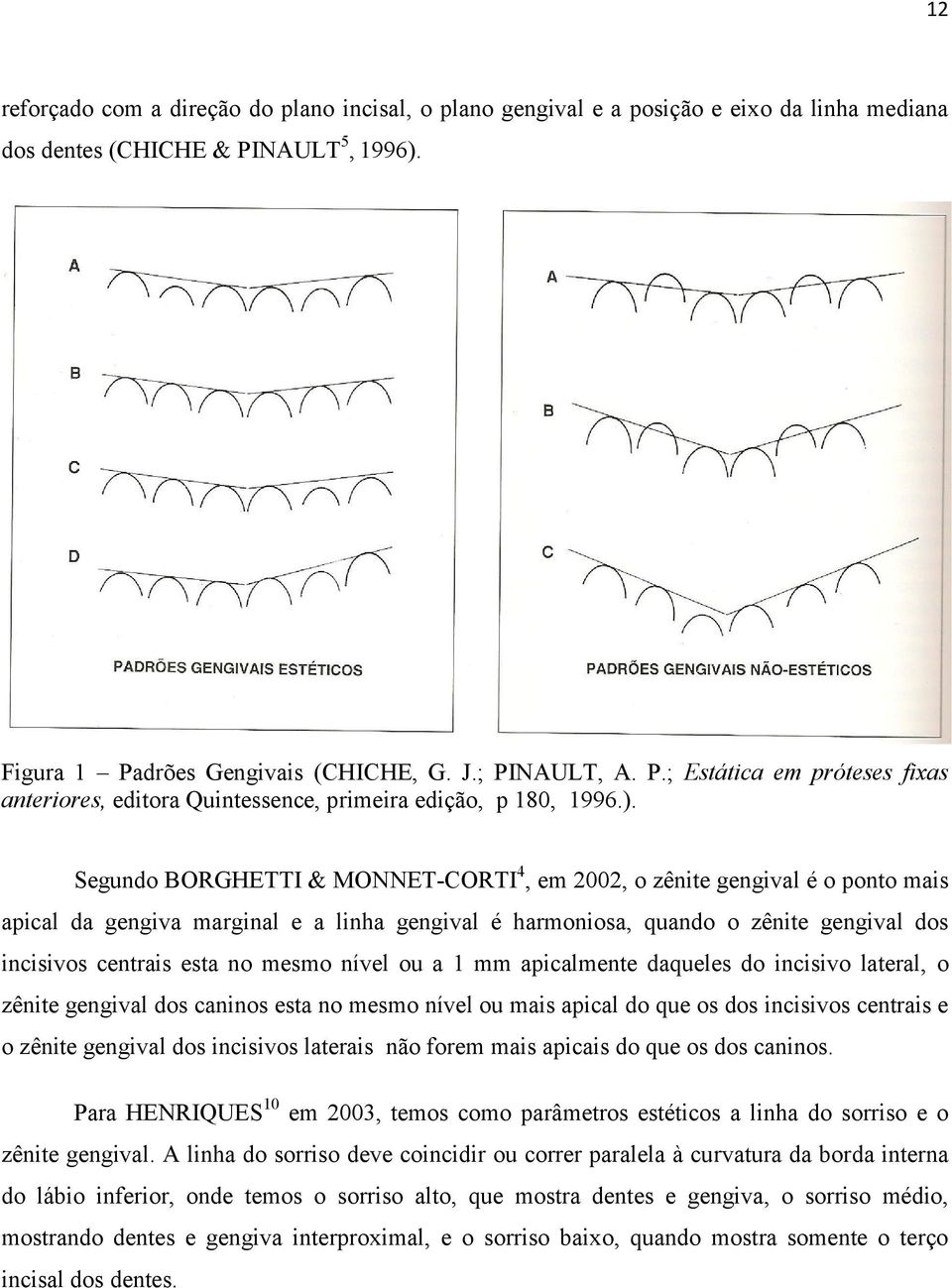 Figura 1 Padrões Gengivais (CHICHE, G. J.; PINAULT, A. P.; Estática em próteses fixas anteriores, editora Quintessence, primeira edição, p 180, 1996.).