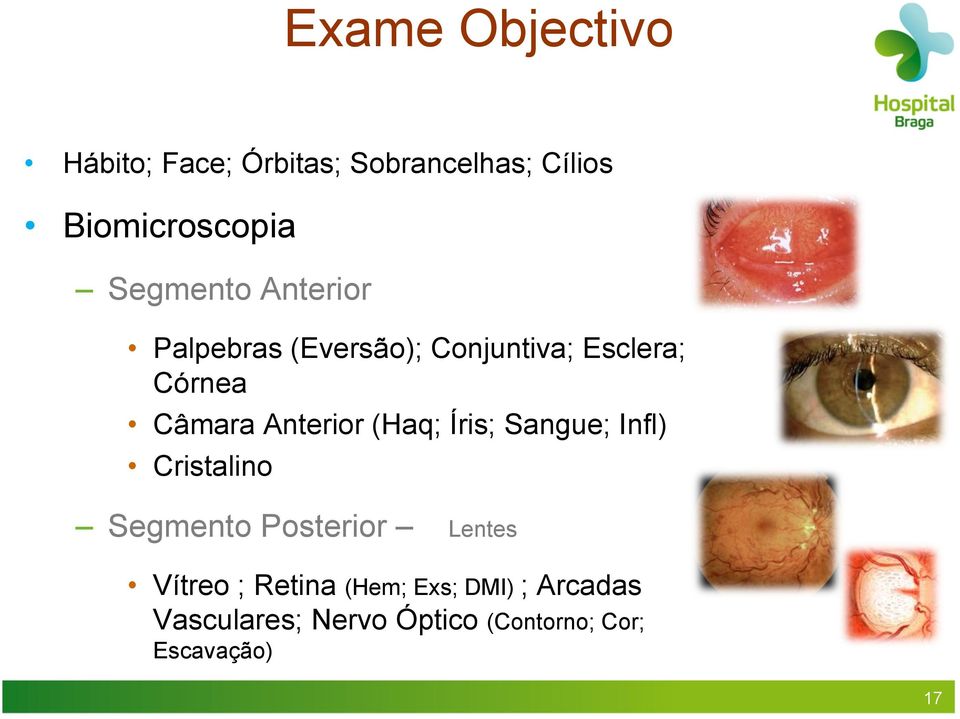 Anterior (Haq; Íris; Sangue; Infl) Cristalino Segmento Posterior Lentes Vítreo