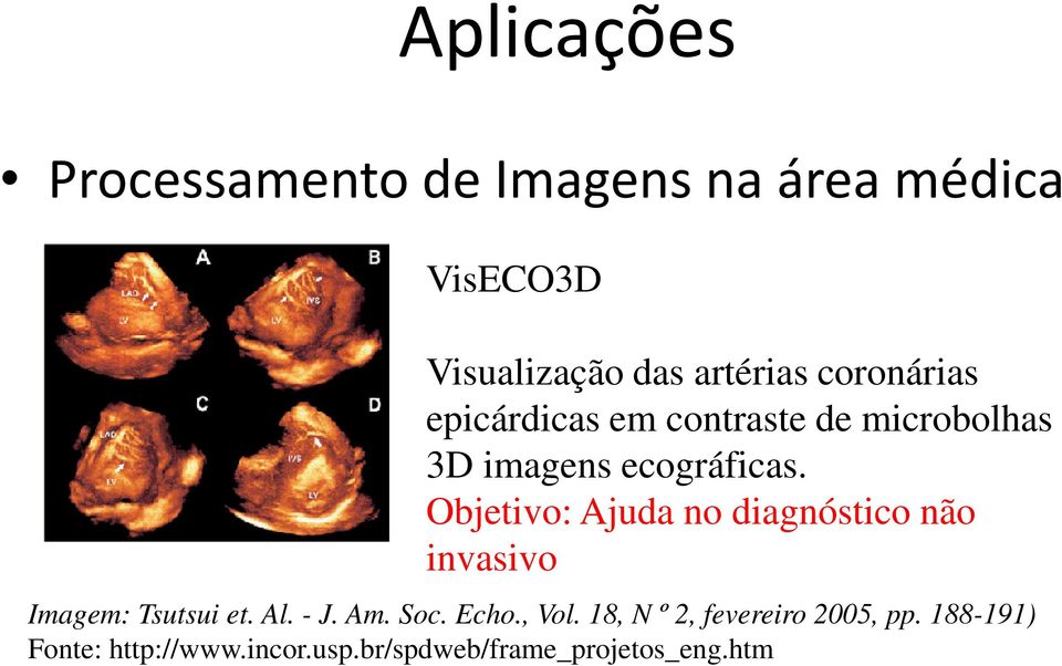 Objetivo: Ajuda no diagnóstico não invasivo Imagem: Tsutsui et. Al. - J. Am. Soc. Echo.