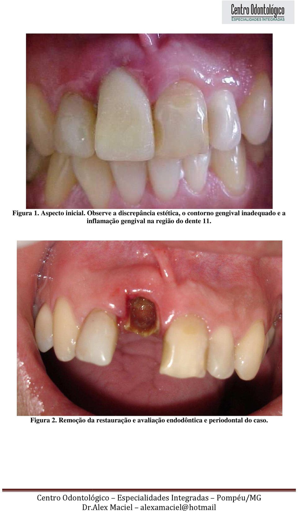 inadequado e a inflamação gengival na região do dente