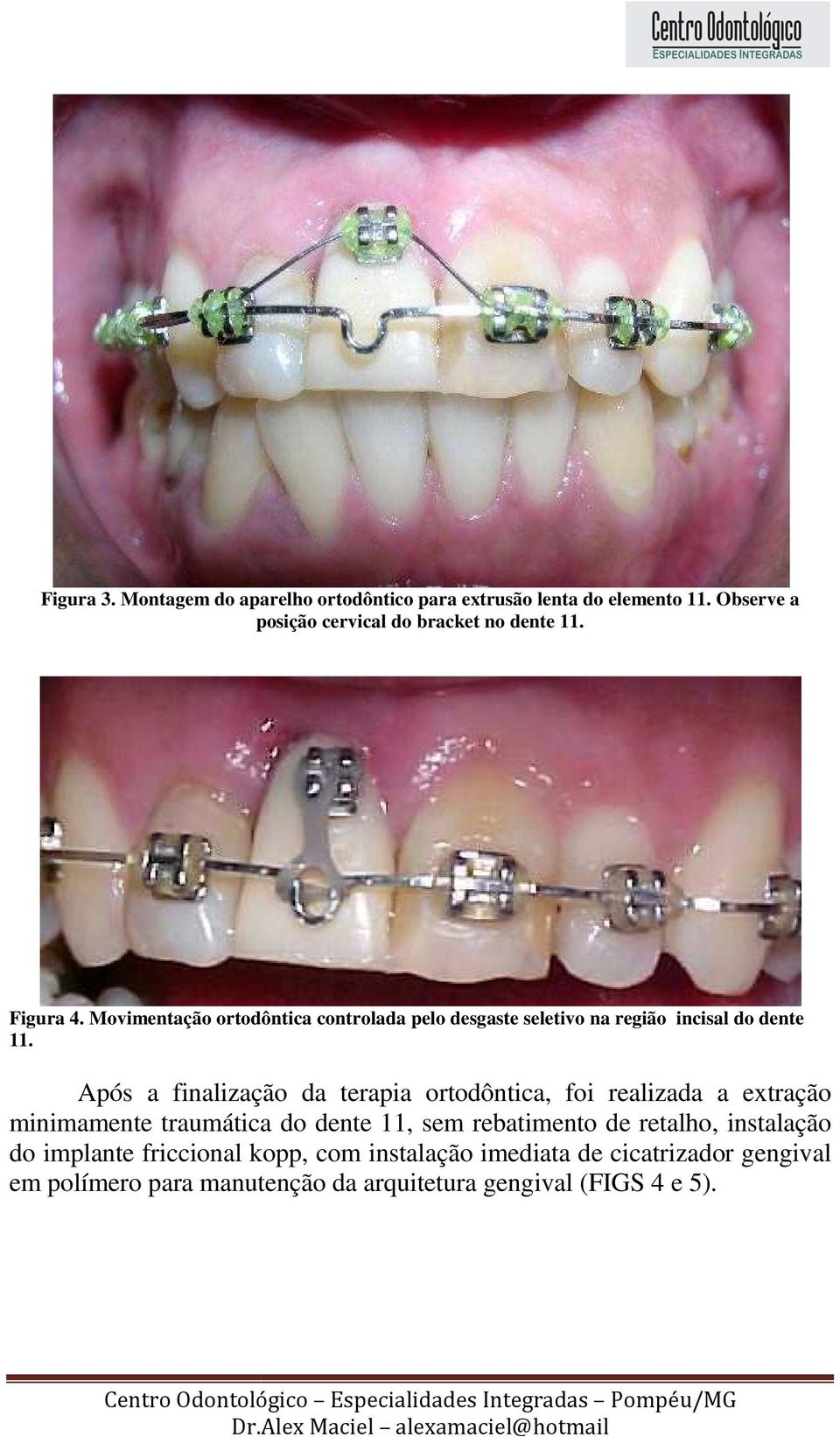 Após a finalização da terapia ortodôntica, foi realizada a extração minimamente traumática do dente 11, sem rebatimento de