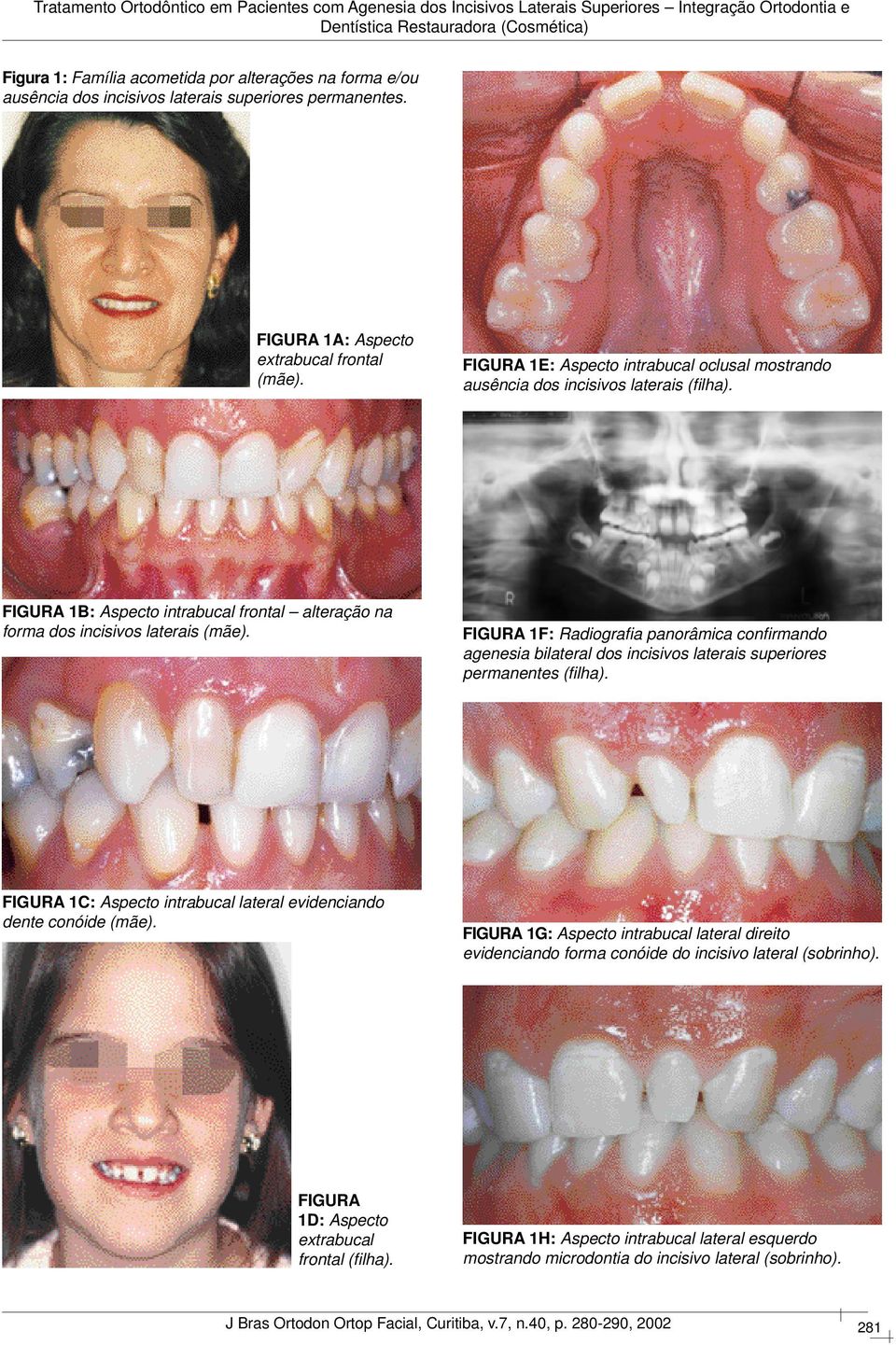 FIGURA 1F: Radiografi a panorâmica confi rmando agenesia bilateral dos incisivos laterais superiores permanentes (fi lha). FIGURA 1C: Aspecto intrabucal lateral evidenciando dente conóide (mãe).