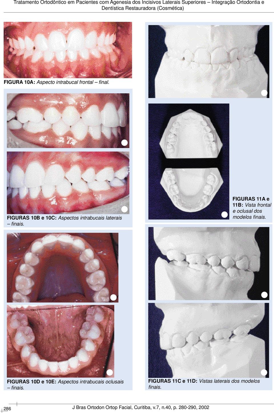 FIGURAS 11A e 11B: Vista frontal e oclusal dos modelos fi nais.