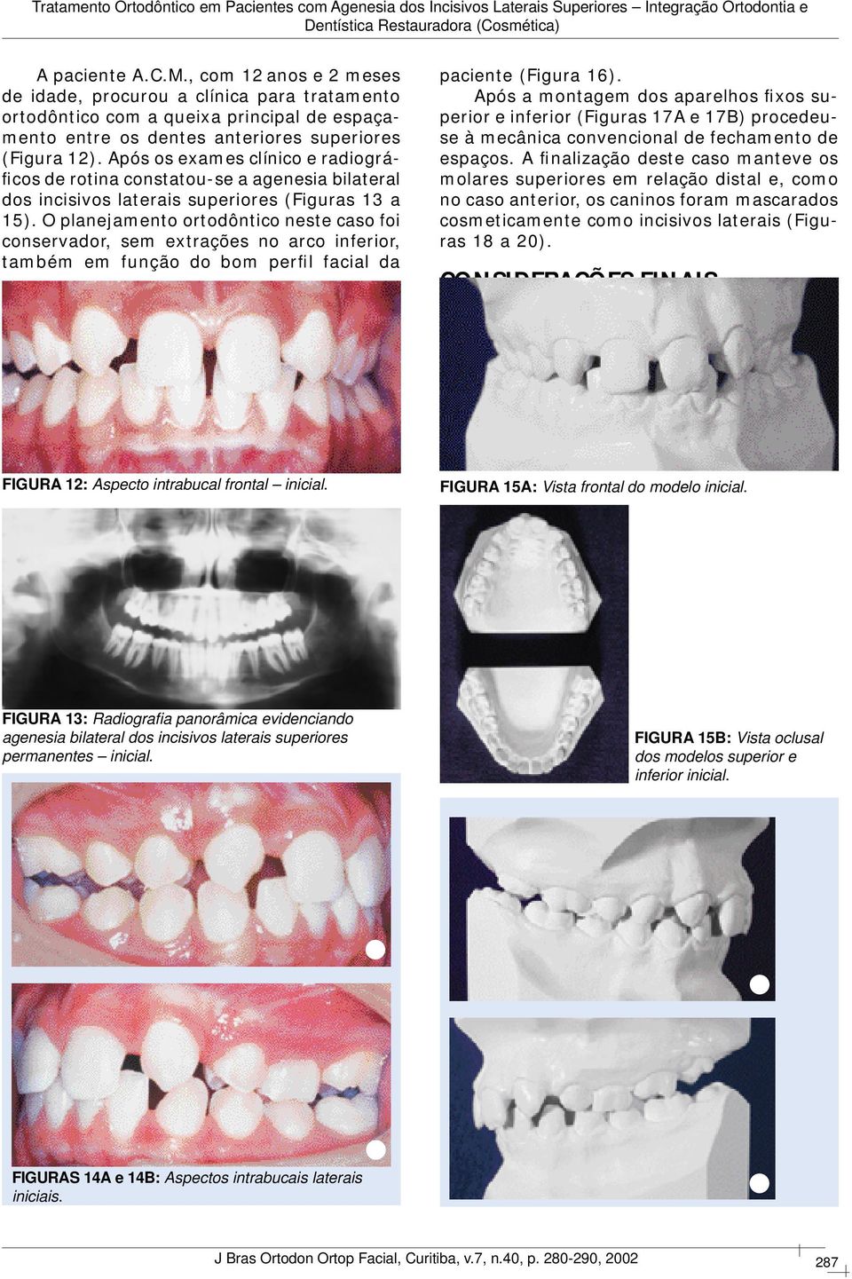 O planejamento ortodôntico neste caso foi conservador, sem extrações no arco inferior, também em função do bom perfil facial da paciente (Figura 16).