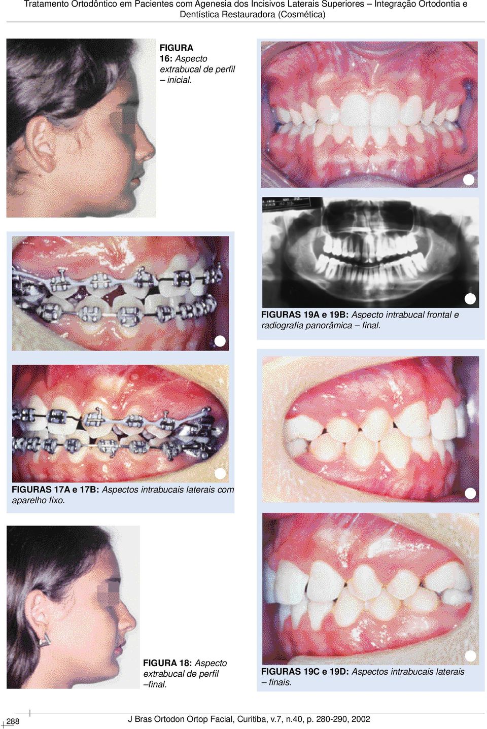 nal. FIGURAS 17A e 17B: Aspectos intrabucais laterais com aparelho fi xo.