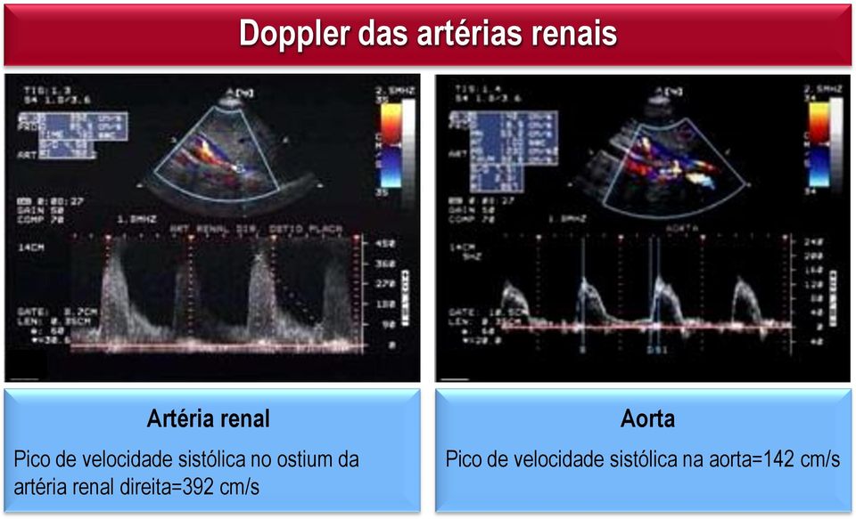 artéria renal direita=392 cm/s Aorta Pico